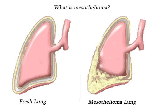 What-is-mesothelioma