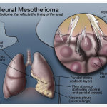 pleural mesothelioma