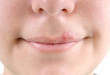 Herpes – Make the Pain Go Away One in five people has genital herpes and most of them don’t even know it.