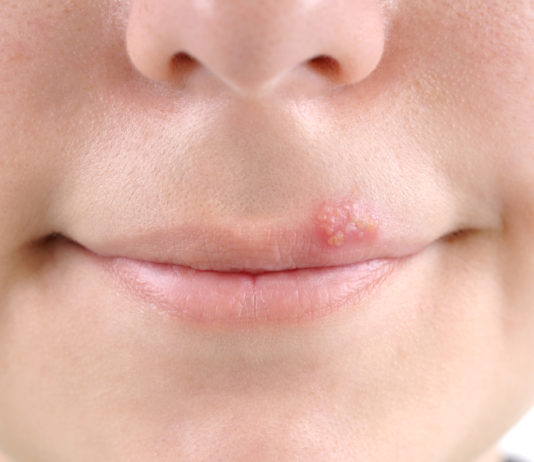 Herpes – Make the Pain Go Away One in five people has genital herpes and most of them don’t even know it.