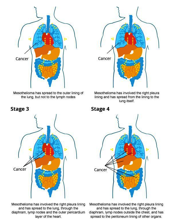 Stages of cancer. Mesothelioma lung Cancer Cancer Mesothelioma. Mesothelioma meme.