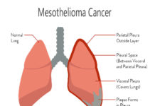 Mesothelioma Symptoms, Diagnosis, and Treatment