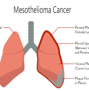 Mesothelioma Symptoms, Diagnosis, and Treatment