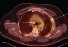 What is Malignant Pleural Mesothelioma? Malignant Pleural Mesothelioma