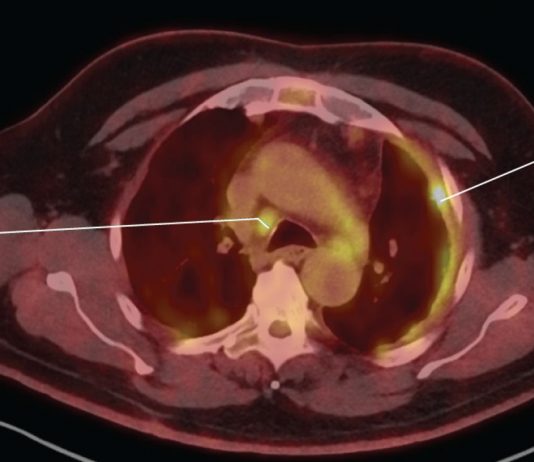 What is Malignant Pleural Mesothelioma? Malignant Pleural Mesothelioma