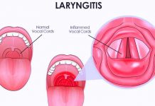 How to Treat Laryngitis? How to Treat Laryngitis? The lymphatic system should be focus of tonic support. And attention should be given to strengthening immune system.
