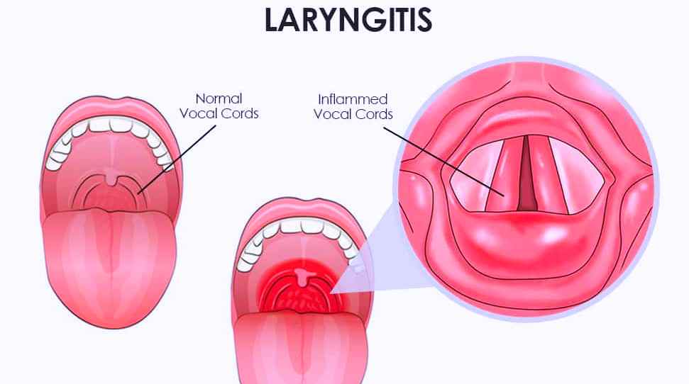 How to Treat Laryngitis? The lymphatic system should be focus of tonic support. And attention should be given to strengthening immune system.