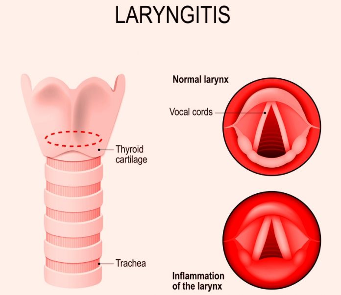 how-to-treat-laryngitis