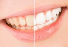 The Causes of Tooth Discoloration Causes of Tooth Discoloration is even in small children can experience tooth discoloration, yellowing and staining for many different reasons