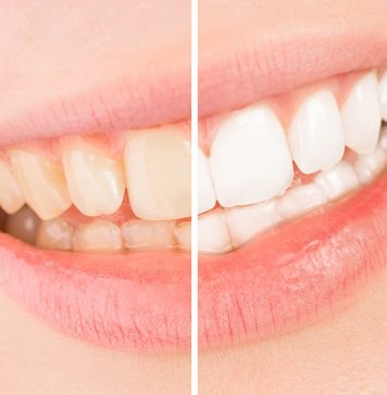 The Causes of Tooth Discoloration Causes of Tooth Discoloration is even in small children can experience tooth discoloration, yellowing and staining for many different reasons