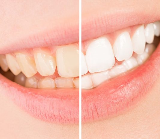 The Causes of Tooth Discoloration Causes of Tooth Discoloration is even in small children can experience tooth discoloration, yellowing and staining for many different reasons