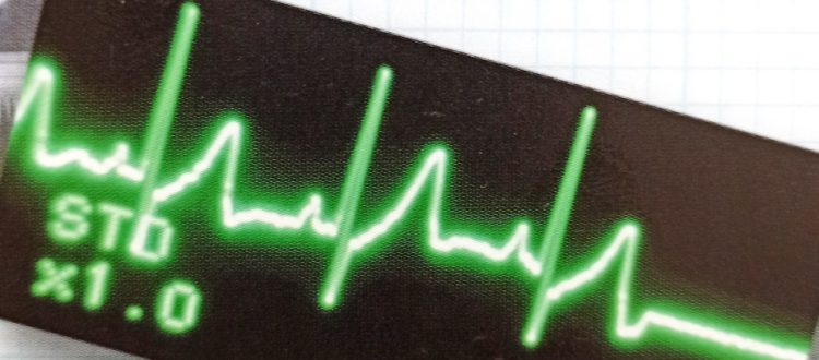 An ECG trace showing the start of a cardiac arrest, which appears on the screen monitor as an unbroken flat line.