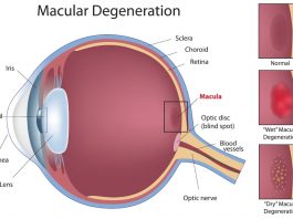 If you have macular degeneration, you should be under the care of your doctor. Do eat a balanced diet rich in fruits and vegetables and low in fatty foods and cholesterol.