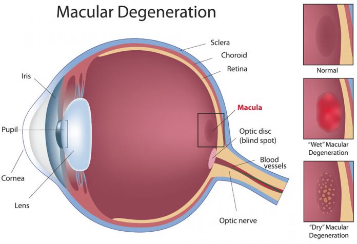 If you have macular degeneration, you should be under the care of your doctor. Do eat a balanced diet rich in fruits and vegetables and low in fatty foods and cholesterol.