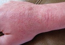 The Common Skin Problems The monounsaturated type in olive oil, for example, and the fat in fish-can actually be fairly healthful for the skin problems.