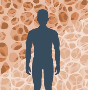 Osteoporosis – Building Strong Bones Osteoporosis is a common condition, affecting more than 24 million Americans, according to U.S. government figures.