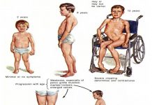 Muscular Dystrophy Symptoms and Treatment Muscular Dystrophy Symptoms and Treatment is very important to know. It is group of genetic conditions in which muscles become weak and wasted