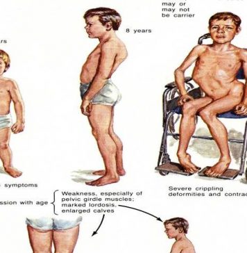 Muscular Dystrophy Symptoms and Treatment Muscular Dystrophy Symptoms and Treatment is very important to know. It is group of genetic conditions in which muscles become weak and wasted