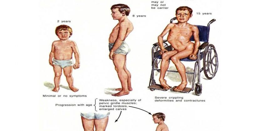 Muscular Dystrophy How Many Affected