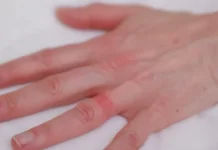 Wedding Ring Dermatitis Cure Save the ring and your skin from Wedding Ring Dermatitis.