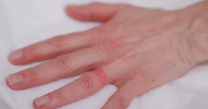 Save the ring and your skin from Wedding Ring Dermatitis.