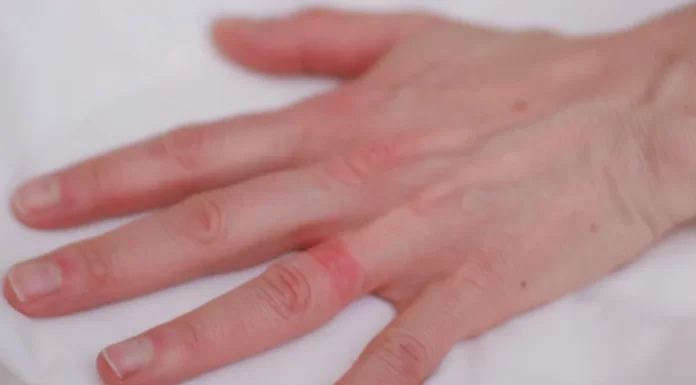 Wedding Ring Dermatitis Cure Save the ring and your skin from Wedding Ring Dermatitis.