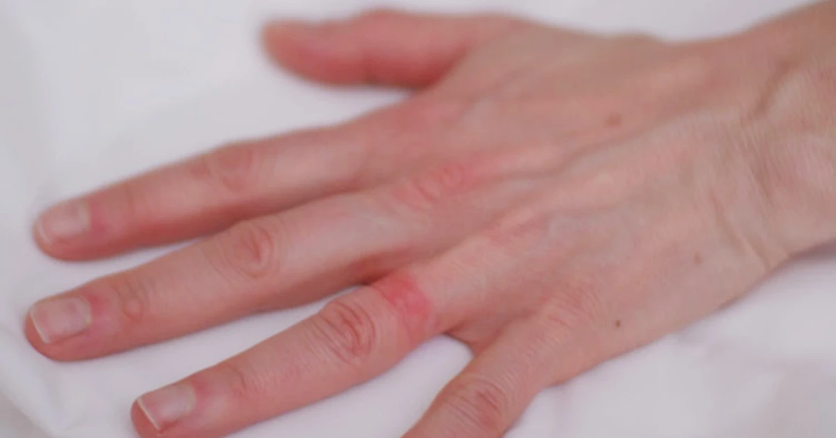 Save the ring and your skin from Wedding Ring Dermatitis.