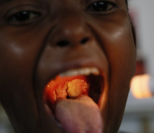 How is Diphtheria Controlled? Diphtheria is a serious disease. How is Diphtheria Controlled? It is caused by bacteria, and illness starts a few days after the bacteria enter the body.