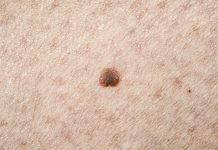 Malignant melanoma, Causes, Risks and Symptoms Malignant melanomas can develop on any part of the body but appear most commonly on sun exposed areas.