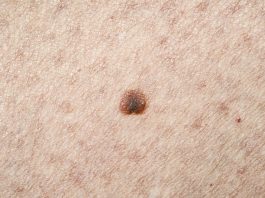Malignant melanomas can develop on any part of the body but appear most commonly on sun exposed areas.