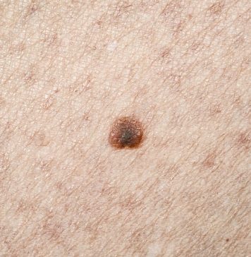 Malignant melanoma, Causes, Risks and Symptoms Malignant melanomas can develop on any part of the body but appear most commonly on sun exposed areas.