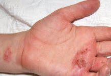 Eczema Symptoms, Treatment, and Causes