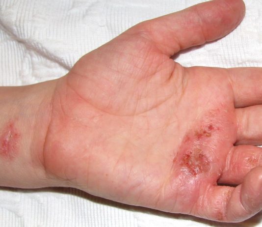 Eczema Symptoms, Treatment, and Causes