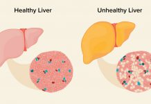 Fatty Liver Remedies – How to Reverse Fatty Liver Disease Naturally Fatty Liver Remedies: How to Reverse Fatty Liver Disease Naturally