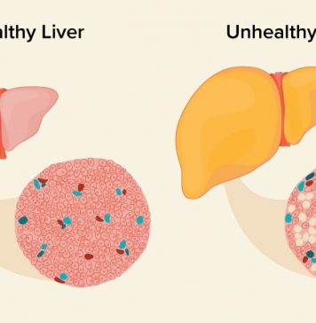 Fatty Liver Remedies – How to Reverse Fatty Liver Disease Naturally Fatty Liver Remedies: How to Reverse Fatty Liver Disease Naturally