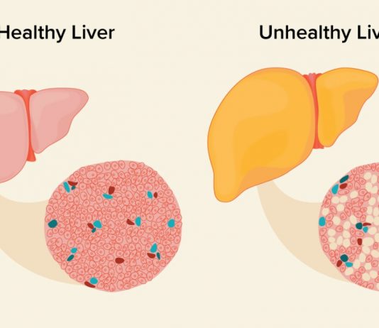 Fatty Liver Remedies – How to Reverse Fatty Liver Disease Naturally Fatty Liver Remedies: How to Reverse Fatty Liver Disease Naturally