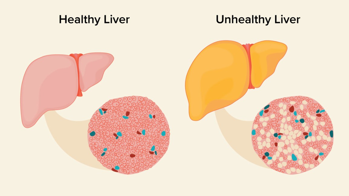 Fatty Liver Remedies: How to Reverse Fatty Liver Disease Naturally