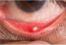 Concretions in the Eye Concretions in the eye - If you've ever looked in the mirror and seen a white or yellow spot on your eye, you may have wondered what it was.