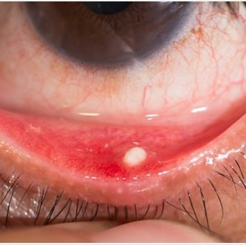 Concretions in the Eye Concretions in the eye - If you've ever looked in the mirror and seen a white or yellow spot on your eye, you may have wondered what it was.