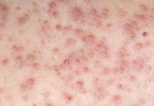 What Are Enlarged Hair Follicles on Breasts? What Are Enlarged Hair Follicles on Breasts?