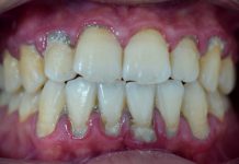 Plaque on your Teeth Plaque on your Teeth