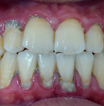 Plaque on your Teeth Plaque on your Teeth