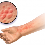 Hives Relief for the Maddening Itch, Hives are small red bumps on your skin that tend to occur for no apparent reason.