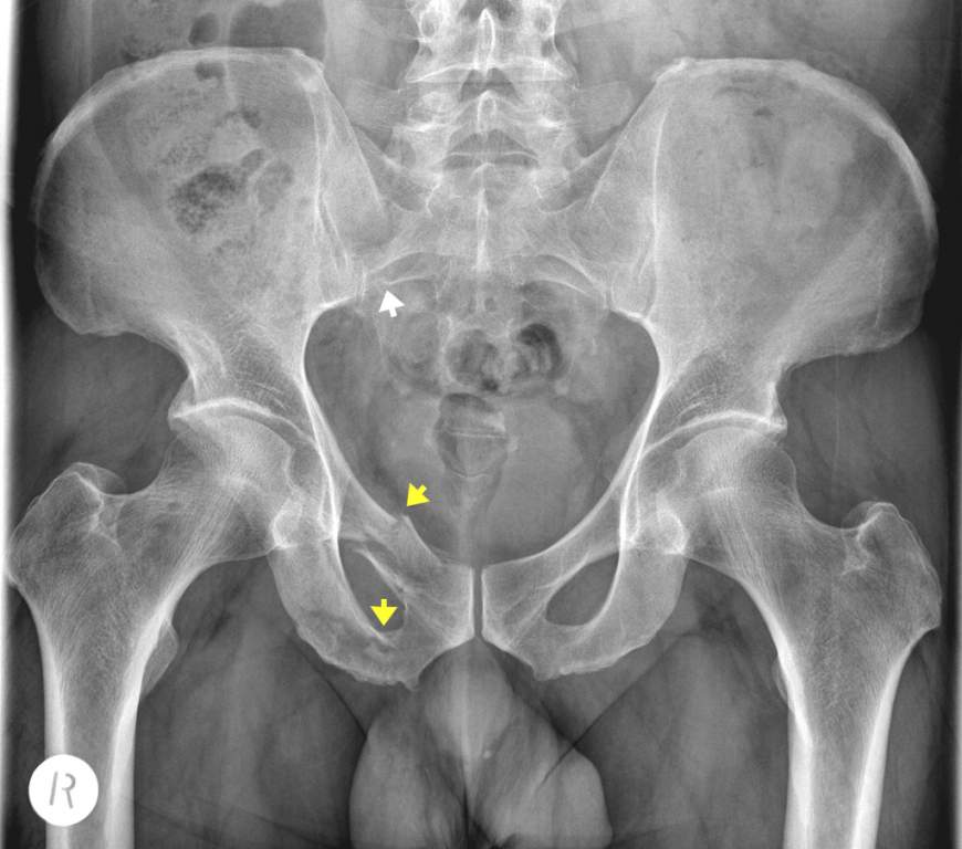 Fracture of the Pelvic Bone 