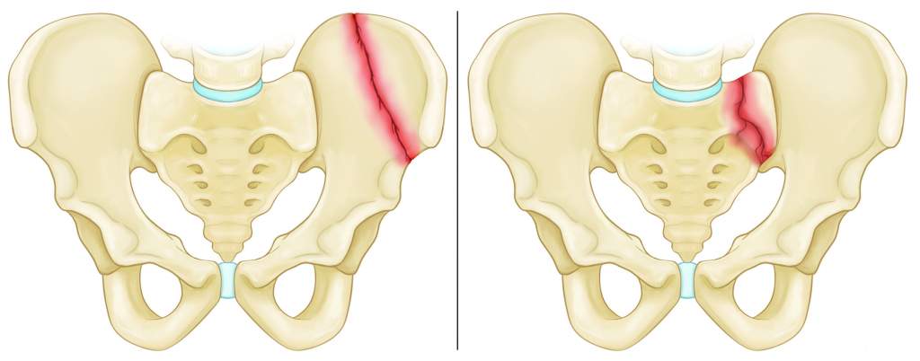 Fracture of the Pelvic Bone