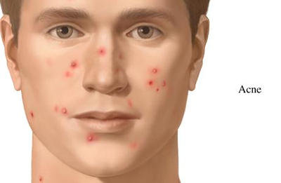 Acne Can be an Embarrassing Problem and Difficult to Treat