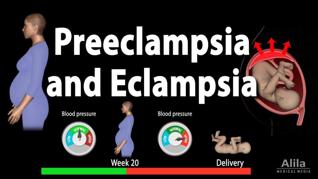 How Does Preeclampsia Affect You? During pregnancy, preeclampsia is a common term. It is important, however, to know what it is, if there are any symptoms and whether or not it can be treated.