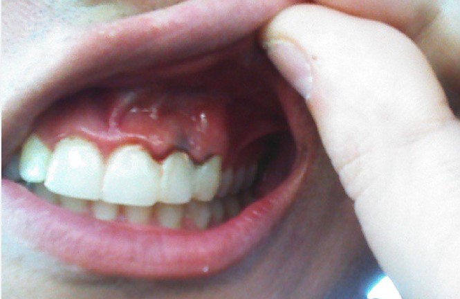 Advance Conventional Treatments for Gum Disease