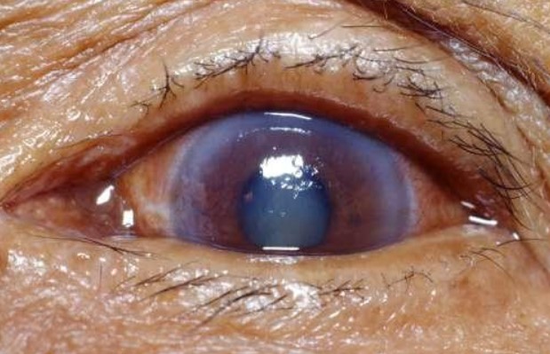 Glaucoma - A Serious Eye Condition