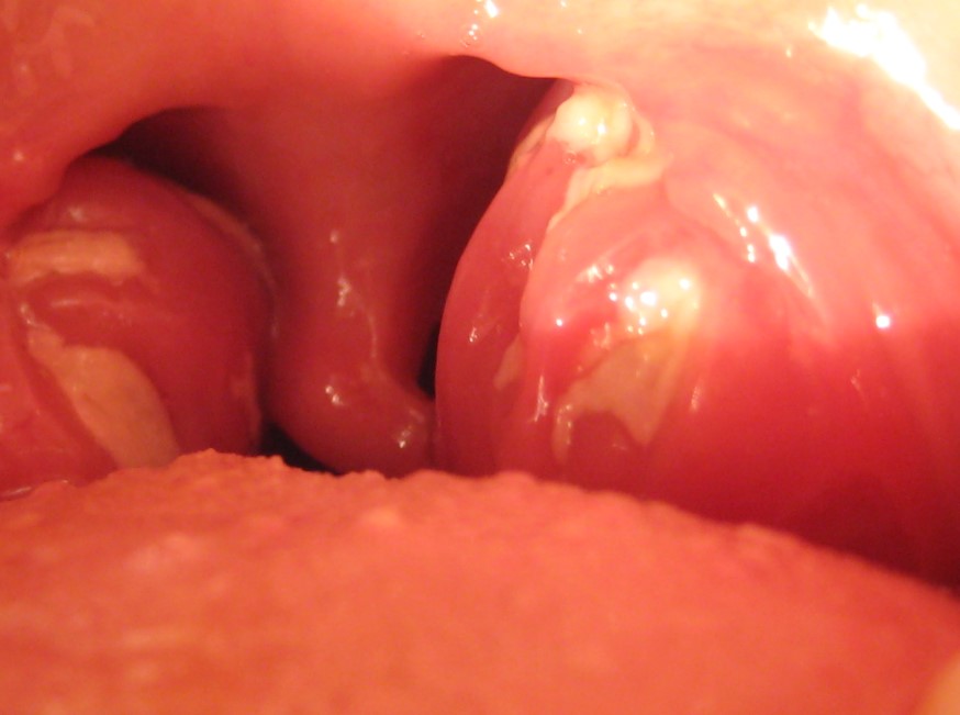 Tonsillitis is primarily caused by toxic conditions that are brought on by a sudden lowering of vitality resulting from exposure and sudden chills.